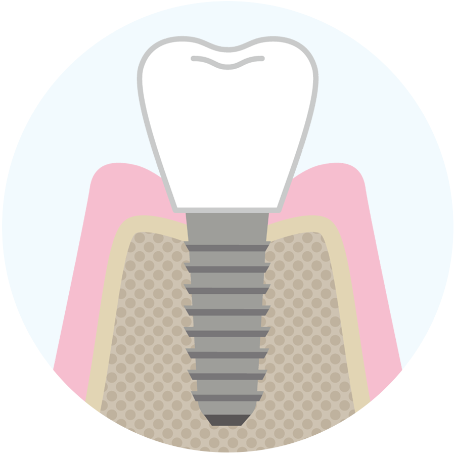 インプラント治療